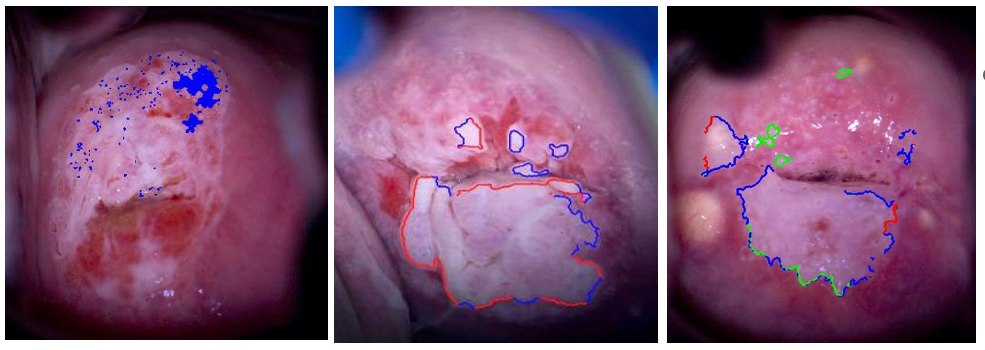 Calibrated and Standardized Colposcopy Imagery — acetowhite lesion mapping with color-coded difference overlays